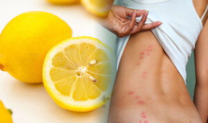 lemonjuice bed bugs remedies